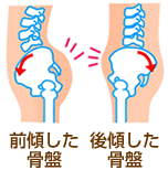 骨盤前傾、骨盤後傾